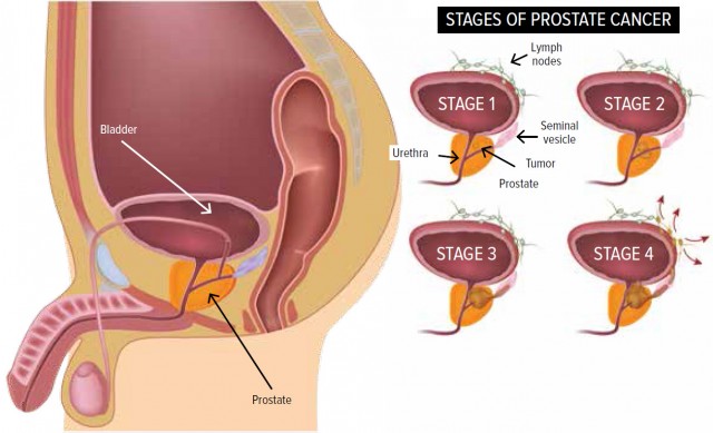 Masturbation After Prostate Removal 110